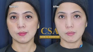 NONSURGICAL EYEBAG TREATMENT USING NEEDLE AND CANNULA TECHNIQUE [upl. by Eeramit]