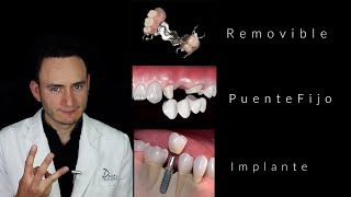 Puentes vs Implantes  ¿Cuál es la mejor opción  Dentista en Querétaro [upl. by Nyllij321]