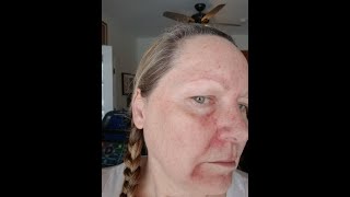 Day 14 Fluorouracil 5 Treatment Basal Cell Carcinoma Actinic Keratosis 11823 5FU Efudex [upl. by Ytsihc164]