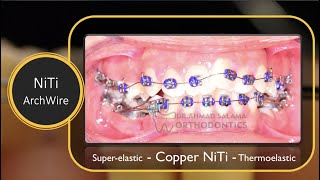 ep15 orthodontic archwire  Niti  copper niti [upl. by Nosrak477]