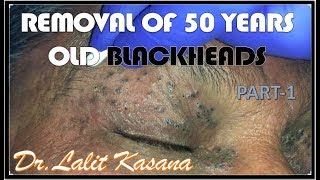 HOW TO REMOVE BLACKHEADS BY COTTON BUDS TECHNIQUE by DRLALIT KASANA [upl. by Brunn352]