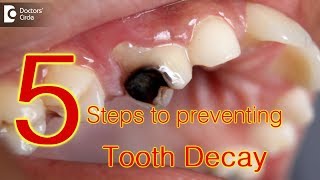 5 Steps to preventing tooth decay  Dr Gopathi Haritha [upl. by Negris932]