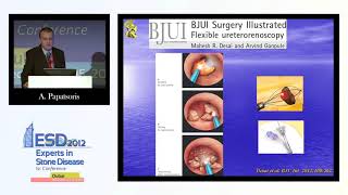 Lithotripsy  Intracorporeal laser lithotripsy [upl. by Lombardo]