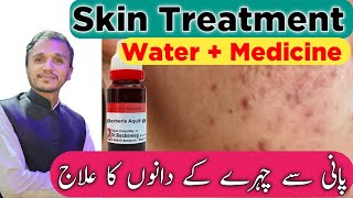 Homeopathic Medicine Berberis Aquifolium Q  How To Glowing Skin  Acne Homeopathic Treatment [upl. by Eitisahc]