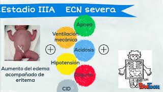 Enterocolitis necrotizante [upl. by Imelida19]