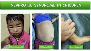 Nephrotic syndrome History mrcpch Clinical [upl. by Anyaj]