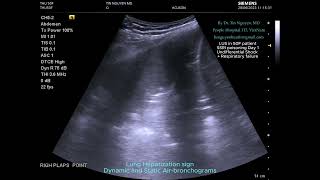 Lung hepatization at Right PLAPS point [upl. by Ititrefen512]