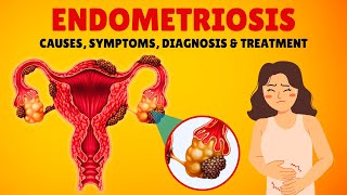 What is Endometriosis Causes Signs and Symptoms Diagnosis amp Treatment [upl. by Pasquale]