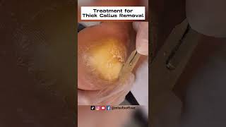 Palmoplantar Keratoderma Relief Expert Treatment for Thick Callus Removal by miss foot fixer [upl. by Yderf326]