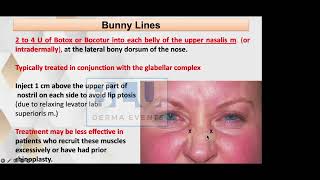 BOTOX Part 6 Bunny lines Nasalis Muscle [upl. by Mellisa]