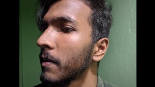 permanent results of minoxidil on beard  man matters beardmax  used for 6 months 🌿 [upl. by Arbma]