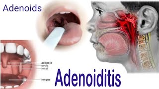 Adenoiditis  Adenoids  Symptoms Causes Complications Diagnosis and Treatment [upl. by Tillman690]