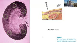 Pediatric FSGS and the Utility of Lipopheresis CME Recording [upl. by Latsyrcal29]