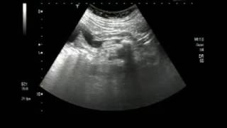 Ultrasound video showing multiple stones in the ureter [upl. by Herwig]