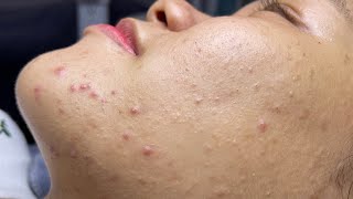 ACNE TREATMENT VU QUYNH MI  Perennial Blackheads On Girl Face 2024FULL [upl. by Acacia]