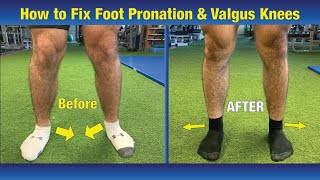 VERY EFFECTIVE Way to FIX Pronated feet amp Knees Caving In Valgus Knees [upl. by Bourke]