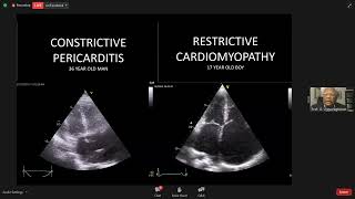 Constrictive Pericarditis amp Restrictive Cardiomyopathy Echo Update [upl. by Convery]