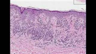 Histopathology SkinCompound Clarks nevus dysplastic nevus [upl. by Cocke232]