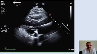 Cardiac tamponade Part 2 Detecting and differentiating pericardial effusion from pleural effusion [upl. by Mariellen677]