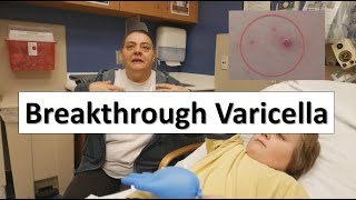 Breakthrough Varicella [upl. by Anale680]