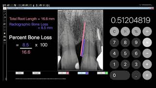 Periodontitis Percent Root Bone Loss [upl. by Catherin]