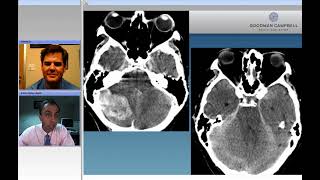 Infratentorial Arteriovenous Fistulas Nuances of Technique for Microsurgical Ligation Preview [upl. by Pail]