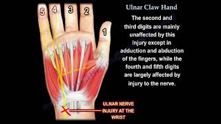 Ulnar Claw Hand Deformity Diagnosis Causes and Differential Diagnosis [upl. by Cyrus]