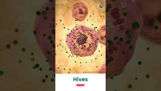 Hives and Your Skin ↪ 3D Medical Animation Shorts Hives Skin HivesDisease SkinDisease [upl. by Tomasz]