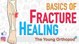 Fracture Healing  ANIMATION  BASICS  The Young Orthopod [upl. by Ecreip]