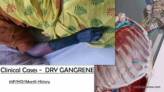 Dry Gangrene Case discussion in brief  Ischemic Heart Disease  3D Anatomy [upl. by Oicnecserc]