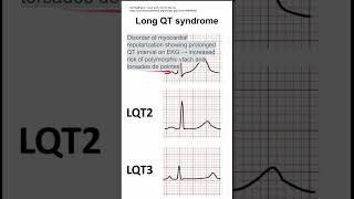 Long QT syndrome [upl. by Belicia]