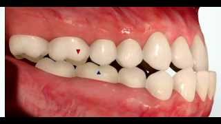 Class III Malocclusion [upl. by Sug]