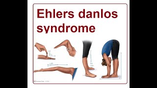 Ehlers Danlos Syndrome  2024 [upl. by Eruot86]