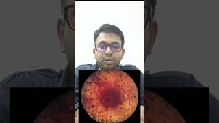 Retinitis pigmentosa signs and symptoms eyedoctor doctortripathy [upl. by Moffitt]