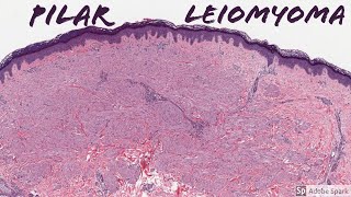 Leiomyoma Pilar Type Piloleiomyoma 5Minute Pathology Pearls [upl. by Bordie]