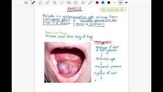 Ranula  Etiology Clinical Features amp Treatment  Surgery  Dr Shankar Dey [upl. by Vaish]