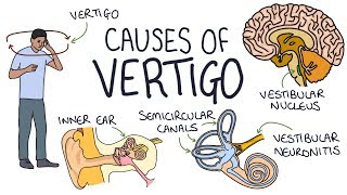 Understanding the Causes of Vertigo [upl. by Atneciv]