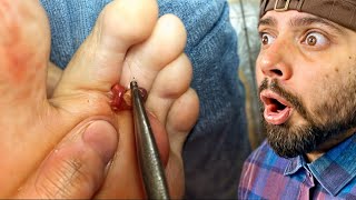 Popping huge blackheads and Giant Pimples Best Pimple Popping Videos [upl. by Eiramyma]