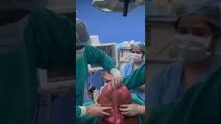 Derotation of Sigmoid Volvulus  Dr Subhadip Sarkar [upl. by Nathanil]