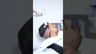 The process of washing after an unshaven hair transplant [upl. by Eelyrag]