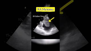 Myxoma in RA  Echocardiography For Beginners echocardiogram shorts [upl. by Ansilma]