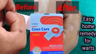 My experience with corncaps Home remedy for wart wart homeremedies [upl. by Armil]