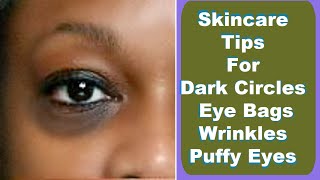 Get Rid of Dark Circles FAST with These Shocking Skincare Tips [upl. by Suoiluj]