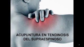 ACUPUNTURA EN TENDINOSIS DEL SUPRAESPINOSO [upl. by Melamie208]