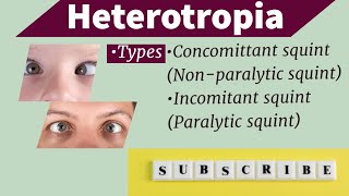 heterotropia part1 Concomitant squintEsotropiaExotropia Nonparalytic squint [upl. by Mcdonald]