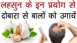 दोबारा से बालों को उगायेंगंजेपन का रामबाण इलाज लहसुन से  Grow Your Hair With Garlic In Hindi [upl. by Aradnahc]