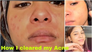 Bohat Muskil Sy Skin Sahi Howi Hai  How I cleared my Acne  perfect life family vlog [upl. by Aryaz371]