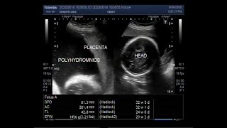 Ultrasound Video showing Smallsized fetal limbs with polyhydramnios [upl. by Luz]