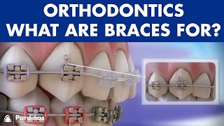 How Braces Work Elements of the orthodontic treatment and its role © [upl. by Yrohcaz]