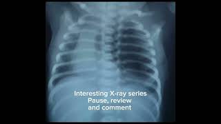 Interesting Xray seriespause review and comment Neonatal Xray nicu [upl. by Lagas268]